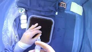 Yueh Needle Hand Positioning During A Paracentesis No Ultrasound Guidance [upl. by Lilhak]