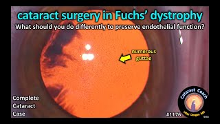 CataractCoach 1176 cataract surgery in Fuchs corneal dystrophy [upl. by Sill960]