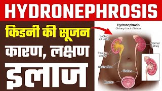 Hydronephrosis हाइड्रोनफ्रोसिस या क‍िडनी में सूजन के कारण लक्षण और इलाज  hydronephrosis treatment [upl. by Eeralav]