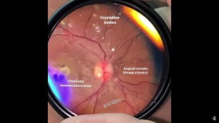 Angioid Streaks in Bruchs membrane  Estrías Angioides na Membrana de Bruch [upl. by Guerra]