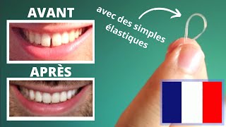 Réduire lécart entre les Dents Du Bonheur en 40 JOURS SANS appareil dentaire [upl. by Vassily41]