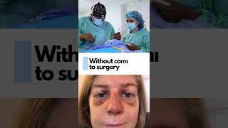 Is an accutane nose job legit MythBusted LiquidRhinoplasty NonSurgicalNoseJob NoseEnhancement [upl. by Honniball]