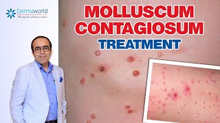 Molluscum Contagiosum Treatment  Dr Rohit Batra [upl. by Arjun167]