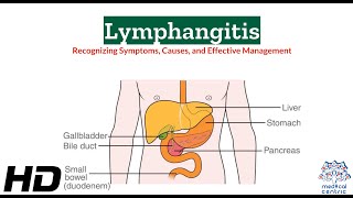 Lymphangitis 101 A Comprehensive Guide to Symptoms and Effects [upl. by Aelegna290]