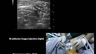 Ultrasound guided lower limb botulinum toxin injections in cerebral palsy Murat Karkucak MD [upl. by Iba38]