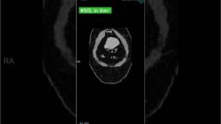 lesion in liver livermass lesion mass ctscan radiology new sorts sol livercancer abdomen [upl. by Rihsab]