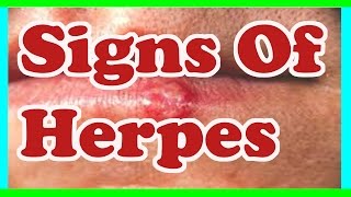 Signs Of herpes  Symptoms Of herpes [upl. by Oluas959]