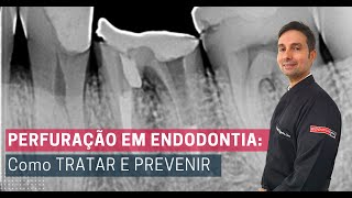 Perfuração em Endodontia Como tratar e prevenir [upl. by Amorita469]