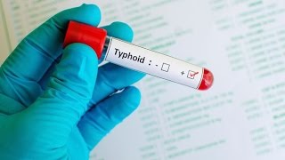 Typhoid Fever [upl. by Orton]