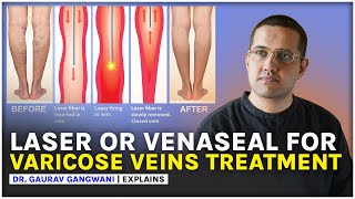 VARICOSE VEINS TREATMENT  LASER ABLATION amp VENASEAL  Dr Gaurav Gangwani [upl. by Hako]