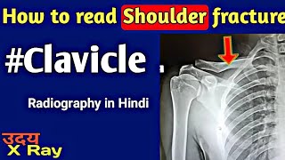 How to read Shoulder Fracture XRayClavicle Fracture Xrayकंधे का फ्रैक्चर एक्सरे कैसे देखें [upl. by Eniamert]