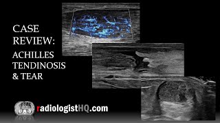 Case Review Ultrasound of Achilles Tendinosis and Tear [upl. by Towney]