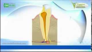 La Ciste Dentale o il Granuloma [upl. by Niak]