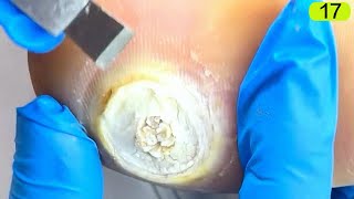 17This plantar wart is round and large [upl. by Sul]