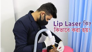 Lip Laser  Lips spot Remove  Lips Peel  Dhanmondi Laser Center [upl. by Foah]