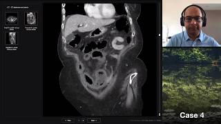 Isolation tutorial Abdominal CT 2 with Vikas Shah [upl. by Robert]