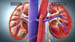 Primary Hyperoxaluria Mechanism of Disease [upl. by Htebazie]