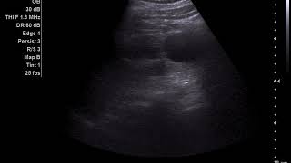 Autosomal Dominant Polycystic Kidneys [upl. by Intirb]