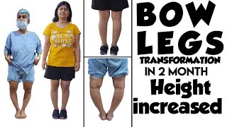 Height increased after bow legs surgery  bow legs transformation genu verum fixed [upl. by Strader]