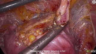 Management of bladder adhesions in TLH [upl. by Jaella943]