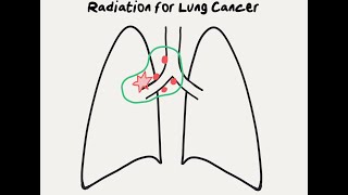 Real Questions  Sterotactic Body Radiation Therapy SBRT [upl. by Stutzman]