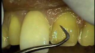 Laminate Veneers with Dr Larry Rosenthal [upl. by Anastas]