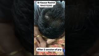 Case Study  PRP Treatment Results after 2 Months  PRP for Hair  Hair Transplant in Mumbai [upl. by Dent414]