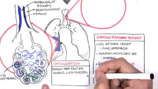 PART I  Pneumonia Overview Lobar and Bronchopneumonia [upl. by Netsrik]