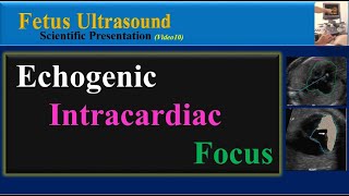 Fetus Ultrasound Echogenic Intracardiac Focus [upl. by Enelear]