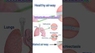 What Is Bronchiectasis bronchiectasis pulmonary lungs [upl. by Onileva97]