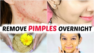 How To Remove Pimples Overnight  Acne Treatment  Anaysa [upl. by Eilrebma]