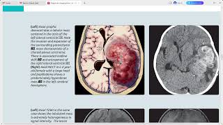 NEOPLASMS BRAIN DIAGNOSTIC IMAGING SERIES [upl. by Rogerio]