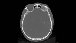 Extradural hemorrhage1 [upl. by Si673]