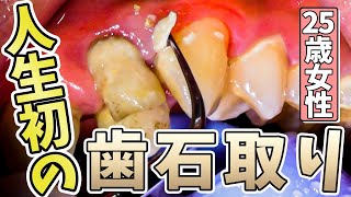 人生初✨の歯石取り‼️25歳女性👩The first tartar removal in my life ️ 25 year old woman 👩 [upl. by Eahsel]