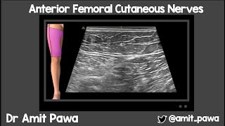 Anterior Femoral Cutaneous Nerve Block [upl. by Hawger887]