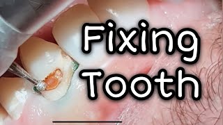 How to fix cavities in front teeth  Dental ASMR [upl. by Nivlam656]