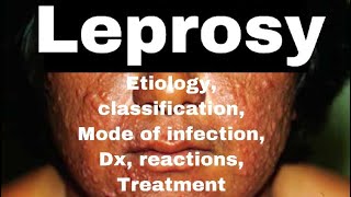 Leprosy Hansens Disease Hansaniasis  etiology classificationdiagnoserxnsMx  MisMedicine [upl. by Kettie806]