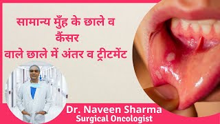 Mouth cancer symptoms in Hindi  Early warning signs of oral cancer  मुंह के कैंसर की पहचान व इलाज [upl. by Ultun357]