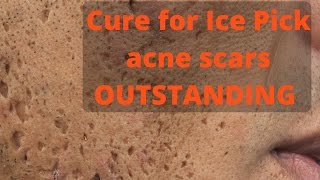 How to treat ice pick acne scars [upl. by Maroney575]