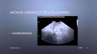 MIOMAS UTERINOS VISUALIZADOS POR ULTRASONIDO [upl. by Liana]