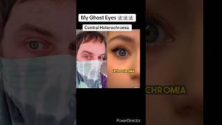 Central Heterochromia Doctors Opinion [upl. by Eanert164]