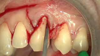 9 Multiple bilaminar technique with single vertical releasing incision in the upper jaw [upl. by Enibas56]