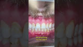 Look what happened to his teeth when he used fluoride shorts [upl. by Kenrick611]