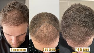 EVOLUCIÓN DE MI CABELLO TRASPLANTADO TRAS SABER QUE TENGO LIQUEN PLANO [upl. by Alet]