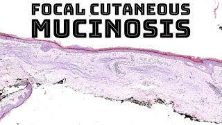 Focal cutaneous mucinosis focal dermal mucinosis pathology dermpath dermatology dermatopathology [upl. by Minsk]