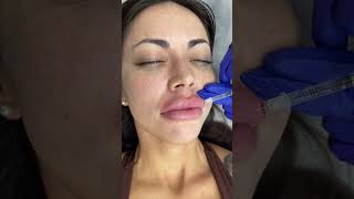 Lips Filler Treatment by our Cathy  Ageless MD [upl. by Oileve]