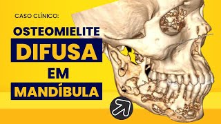 Reabsorção óssea mandibular difusa Uma osteomielite é capaz disso [upl. by Buzzell]