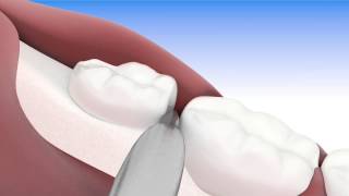 Exodoncia compleja tercer molar semi incluido  Video 3D PASO A PASO [upl. by Thema]