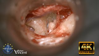 Traumatic Incus Dislocation  Total Ossicular Reconstruction  Malleus Relocation amp Silastic Banding [upl. by Eruot]