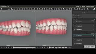 Severe Overjet Reduction with Invisalign and IPR [upl. by Hanson]